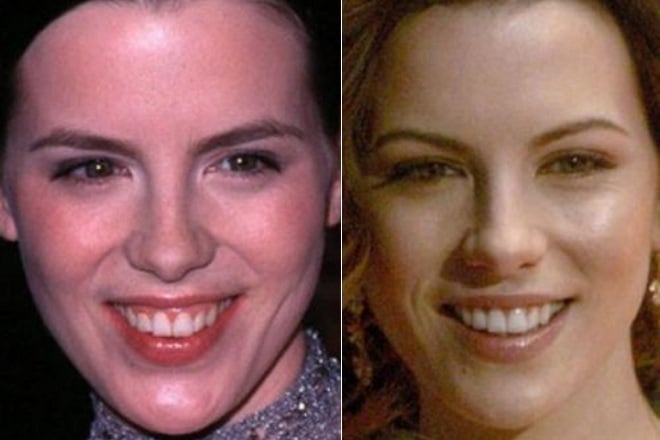 Kate Beckinsale before and after the plastic surgery