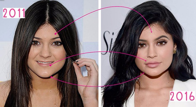 Kylie Jenner before and after plastic surgery