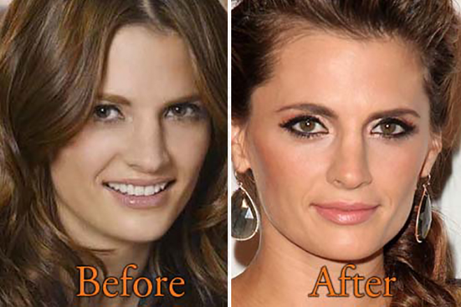 Stana Katic before and after the supposed plastic surgery