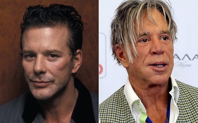 Mickey Rourke before and after plastic surgery