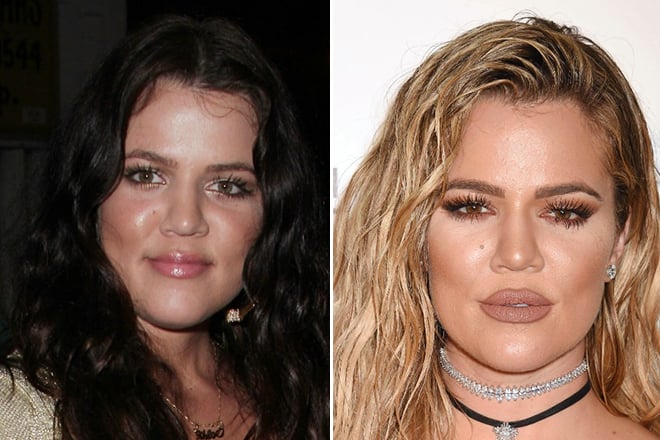 Khloe Kardashian before and after plastic surgery