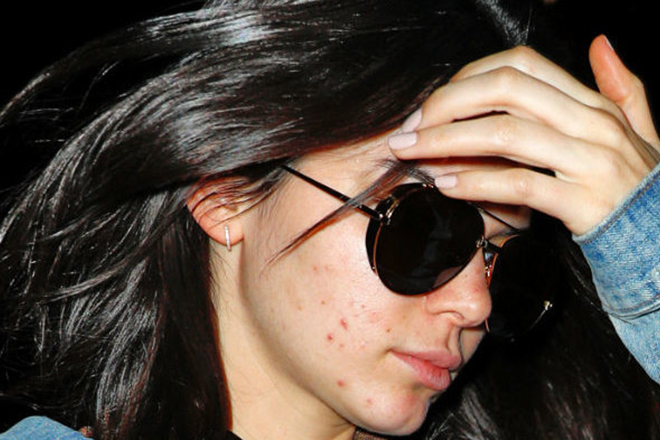 Kendall Jenner with pimples