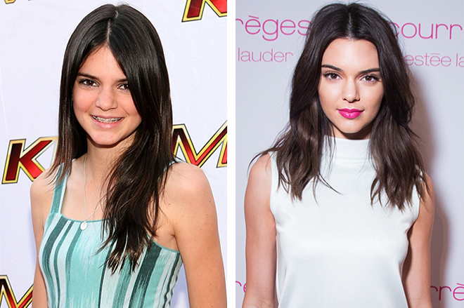 Kendall Jenner before and after rhinoplasty