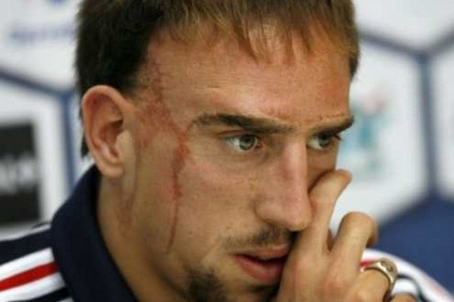 The scar of Franck Ribéry