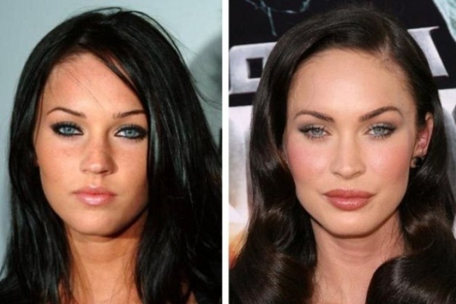 Megan Fox before and after plastic surgery