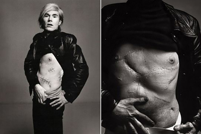 Andy Warhol shows his scars
