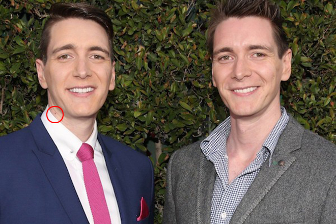 Oliver Phelps has a mole on his neck
