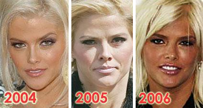 Anna Nicole Smith plastic surgery
