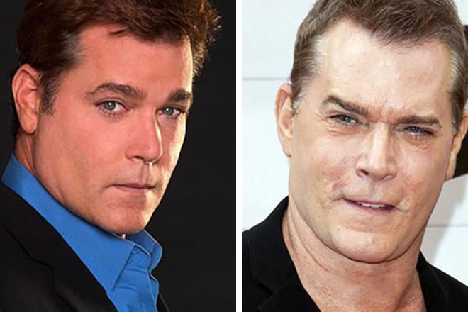 Ray Liotta before and after plastic surgery