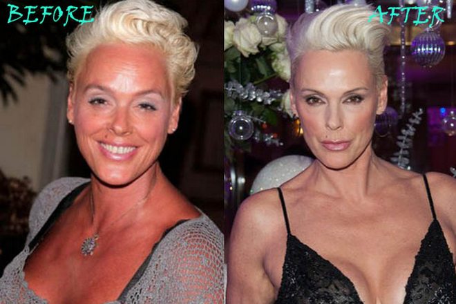 Brigitte Nielsen before and after surgery