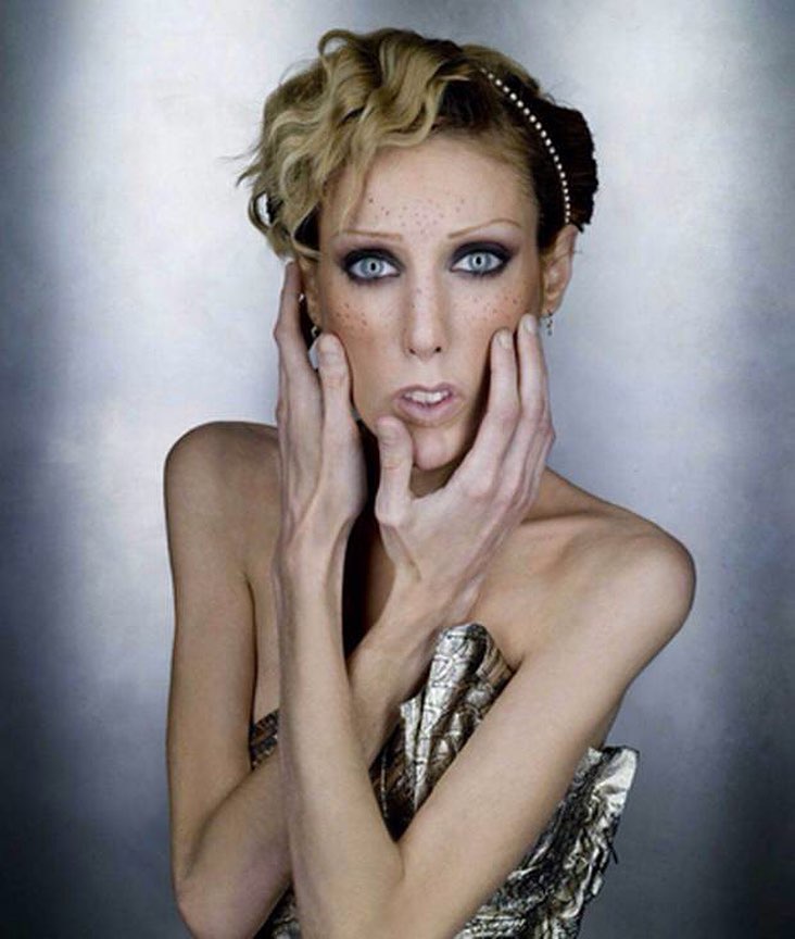 Footpad seng tjener 5 Famous Models Who Suffered From Anorexia